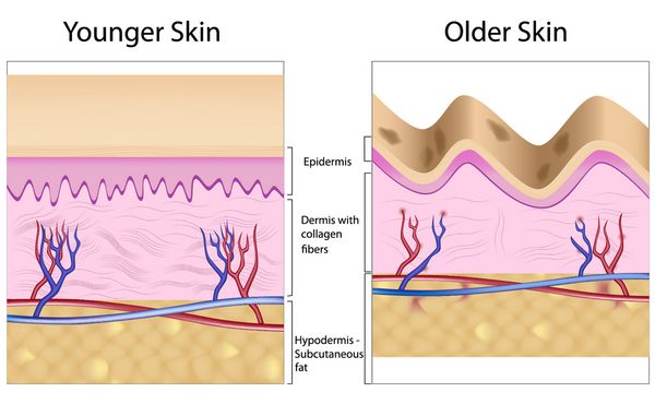 آناتومی پوست قدیمی که با وجود لکه های پیری و چین و چروک ناشی از از دست دادن رشته های کلاژن آتروفی اپیدرم و عروق خونی مشخص می شود