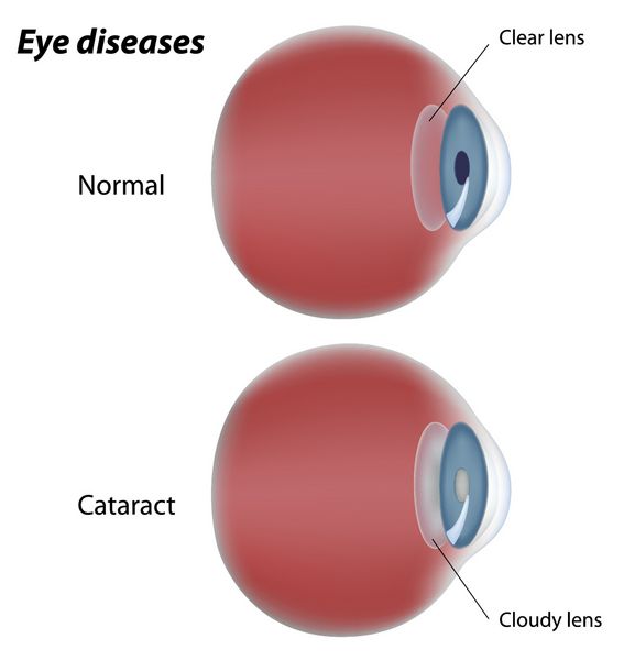 بیماری چشمی آب مروارید