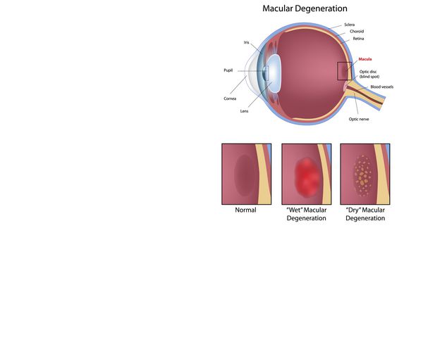 وضعیت چشم دژنراسیون ماکولا