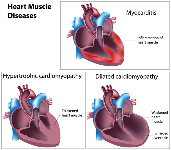 بیماری های عضله قلب