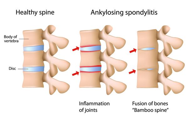 اسپوندیلیت آنکیلوزان ستون فقرات