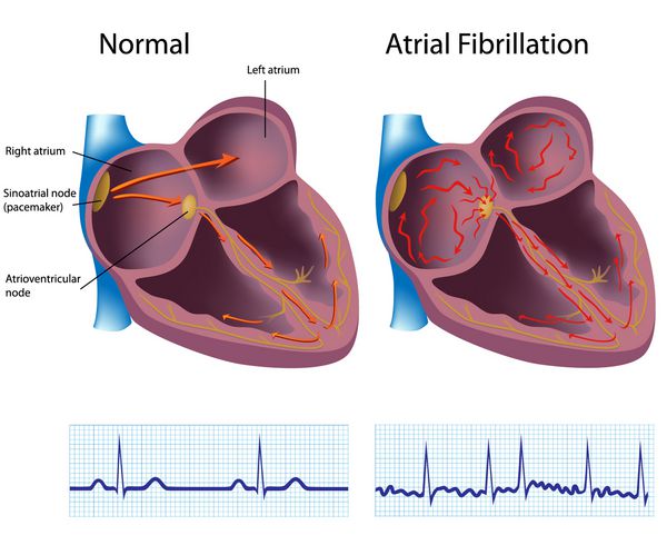 بیماری قلبی - فیبریلاسیون دهلیزی