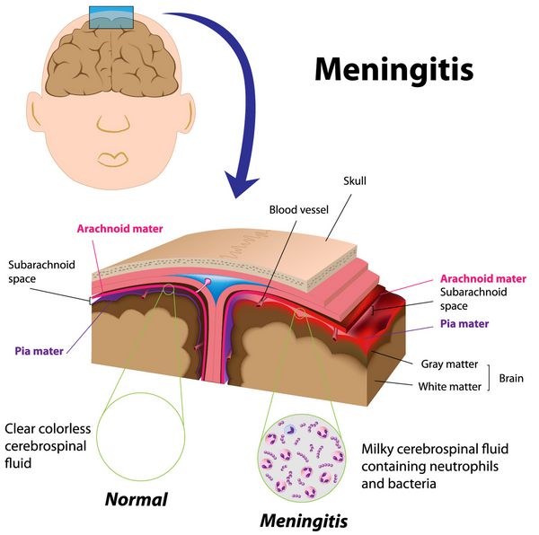 مننژیت - عفونت مننژهای مغز