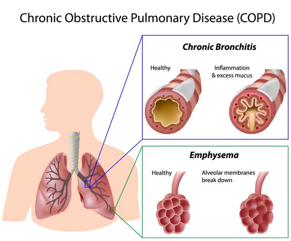 بیماری انسدادی مزمن ریه COPD