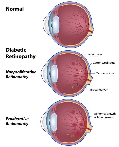 رتینوپاتی دیابتی - بیماری چشم در نتیجه دیابت