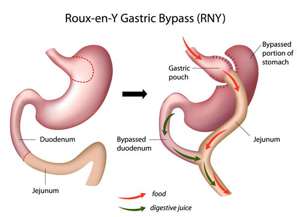 جراحی کاهش وزن Roux-en-Y بای پس معده RNY
