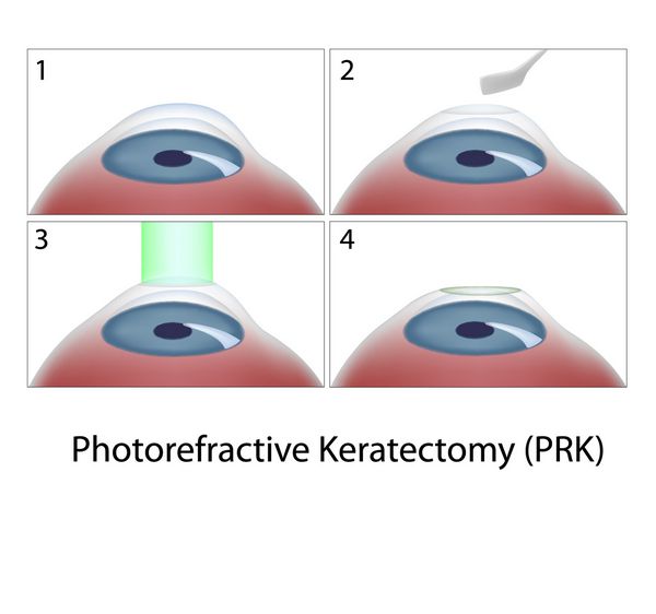 جراحی کراتکتومی فوتورفرکتیو PRK چشم