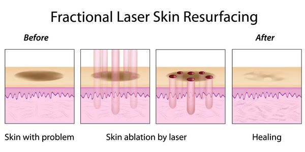 بازسازی پوست با لیزر فرکشنال