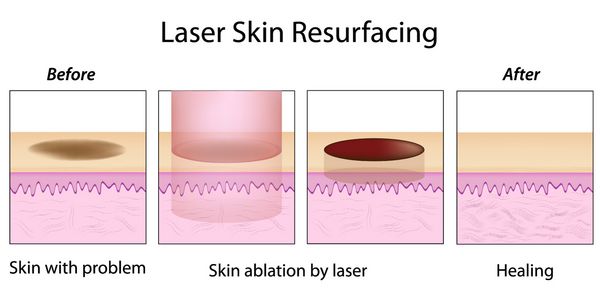 بازسازی پوست با لیزر
