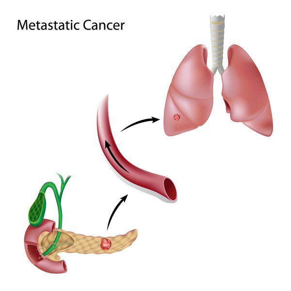سرطان از طریق گردش خون از سرطان اولیه در پانکراس به سرطان ثانویه در ریه گسترش می یابد