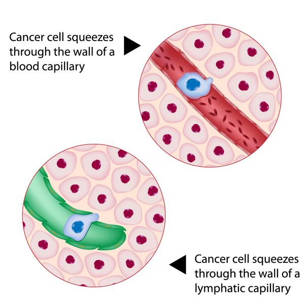 سلول سرطانی در طول متاستاز از طریق خون و عروق لنفاوی فشرده می شود