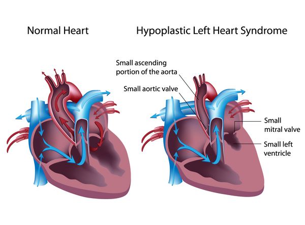 سندرم هیپوپلاستیک قلب چپ