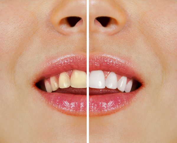 دندان های زن قبل و بعد از سفید کردن