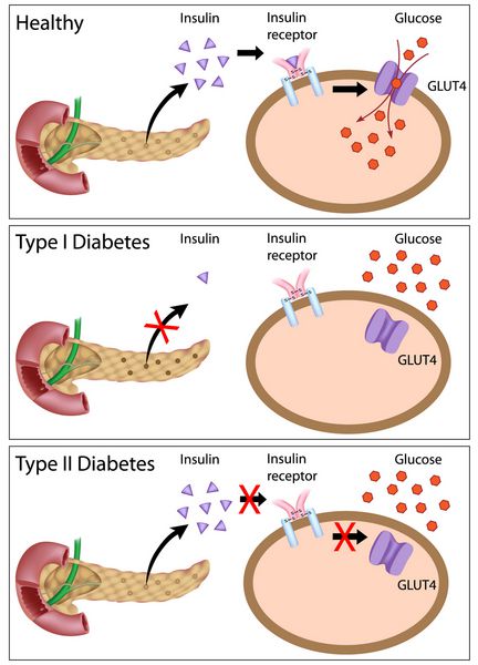 عملکرد انسولین و دیابت نوع 1 و نوع 2