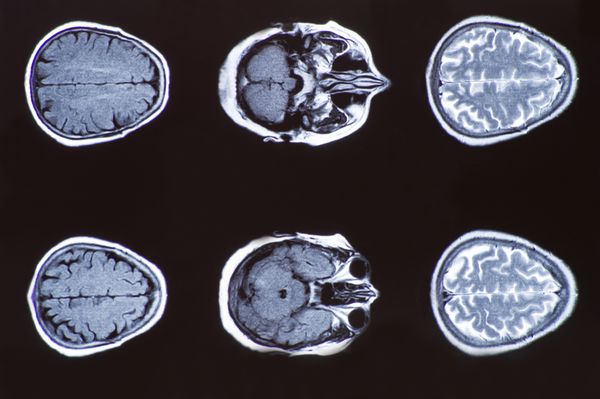 تصویر اشعه ایکس از توموگرافی کامپیوتری مغز