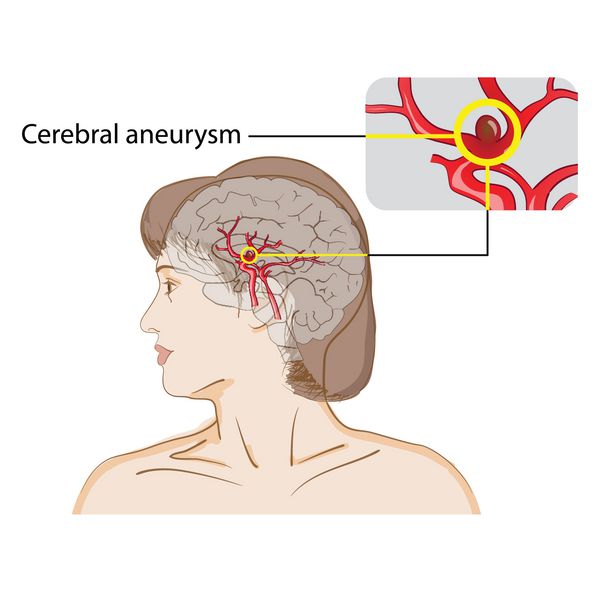 آنوریسم مغزی