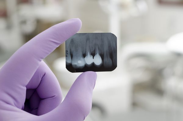 دکتری که اشعه ایکس دندان را در دست گرفته و به آن نگاه می کند