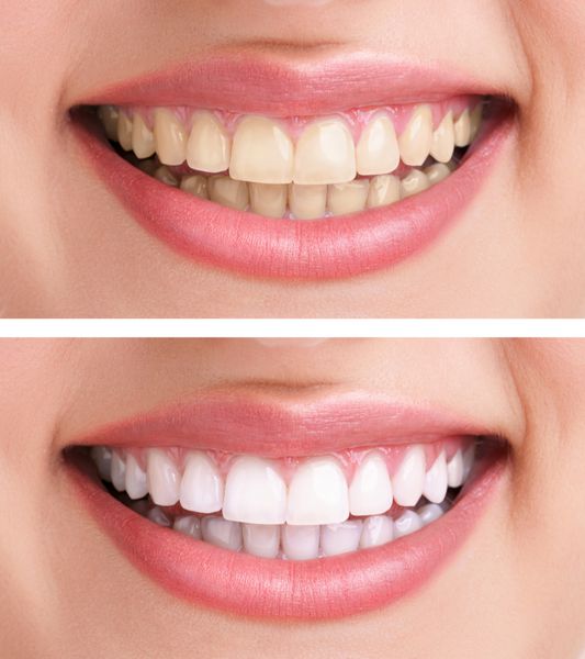 درمان سفید کردن - بلیچینگ قبل و بعد دندان های زن و لبخند از نزدیک ایزوله روی سفید