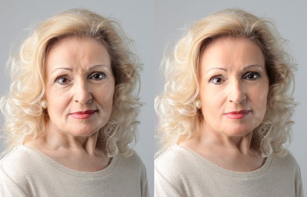 پرتره های زن بالغ قبل و بعد از درمان ضد چروک