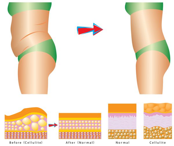 چربی روی شکم سلولیت - بدن زن قبل و بعد سلولیت در مقابل پوست صاف
