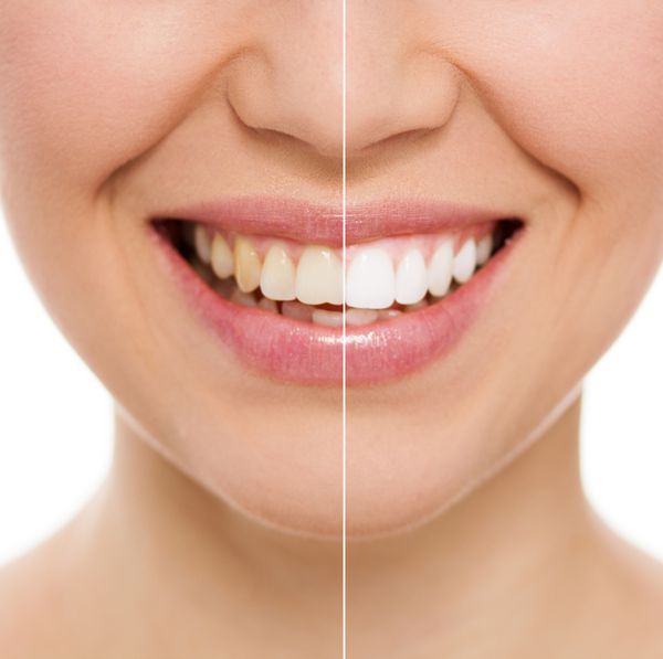قبل و بعد از بلیچینگ یا سفید کردن دندان نمای نزدیک لبخند زن جوان قفقازی