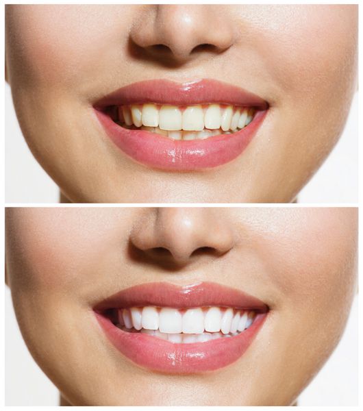 دندان های زن قبل و بعد از سفید کردن روی پس زمینه سفید زن خندان شاد مفهوم سلامت دندان بهداشت دهان