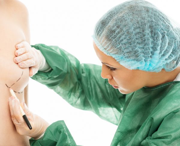 زن جراح پلاستیک در حال کشیدن خطوط بدن برای عمل ایمپلنت سینه