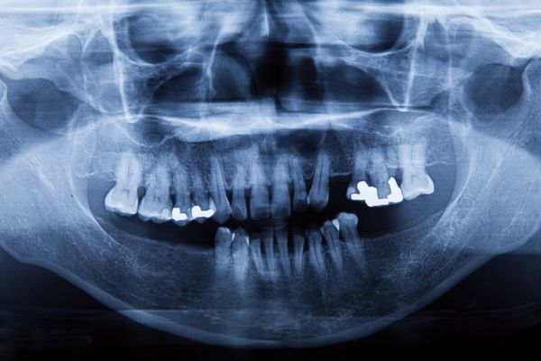 اشعه ایکس پانورامیک دندان در صفحه و فیلم کامپیوتر