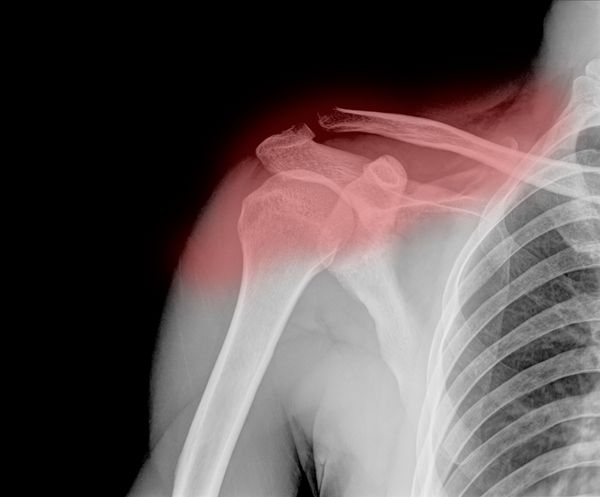 تصویر اشعه ایکس از مفصل دردناک یا آسیب دیده شانه دررفتگی شانه