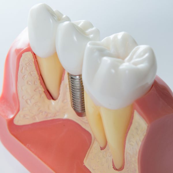 نمای نزدیک از یک مدل ایمپلنت دندانی تمرکز انتخابی