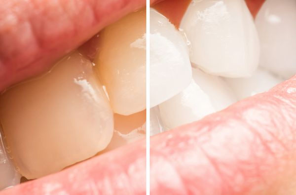 دندان های زن قبل و بعد از عمل سفید کردن در کلینیک دندانپزشکی
