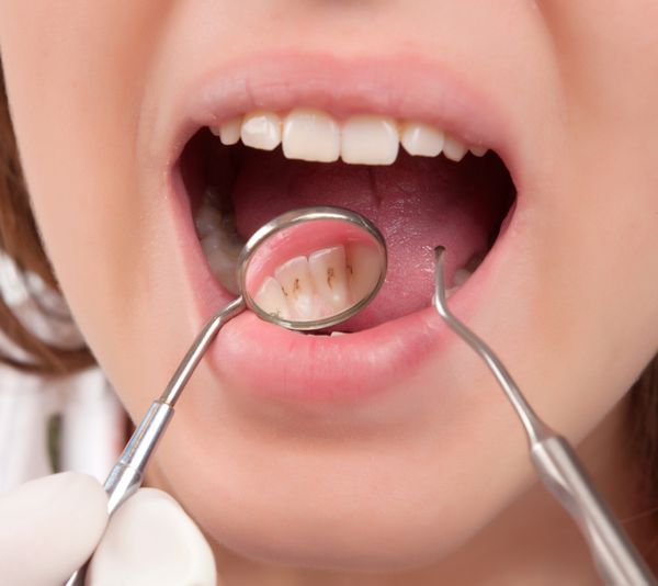 درمان دندان در دندانپزشک