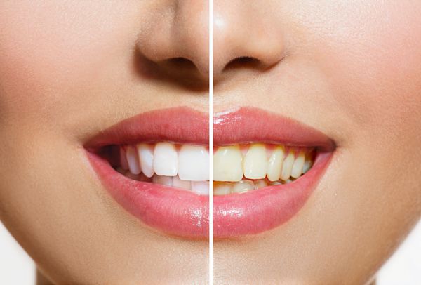 دندان های زن قبل و بعد از سفید کردن بهداشت دهان