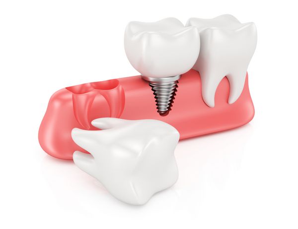 مفهوم کاشت دندان