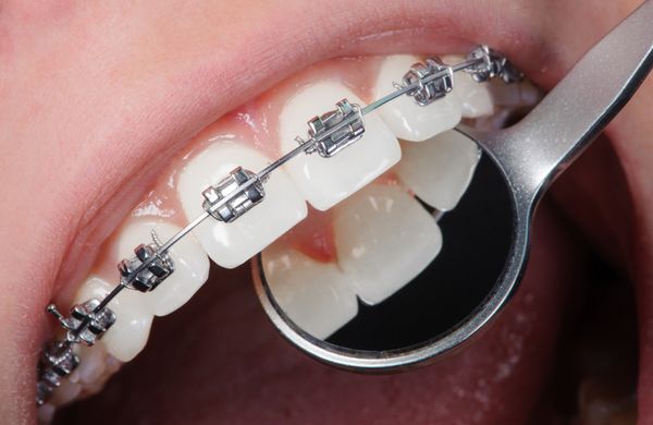 دهان باز نشان دهنده بریس های فولادی ضد زنگ دندان های سالم مفهوم مراقبت از دندان درمان ارتودنسی