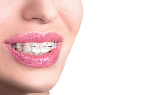 بریس های سرامیکی نزدیک روی دندان لبخند زیبای زن با بریس درمان ارتودنسی مفهوم مراقبت از دندان