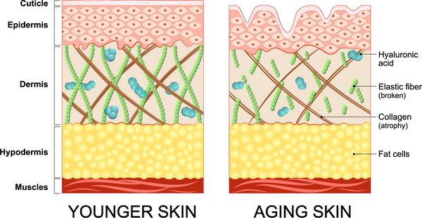 نمودار پوست جوانتر و پوست پیری که کاهش کلاژن و الاستین شکسته را در پوست مسن نشان می دهد