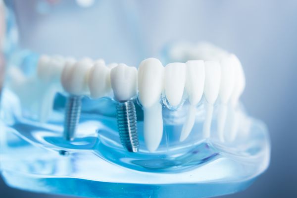 مدل تدریس دانشجوی دندانپزشکی دندانپزشکی که دندان ریشه لثه بیماری لثه پوسیدگی دندان و پلاک را نشان می دهد