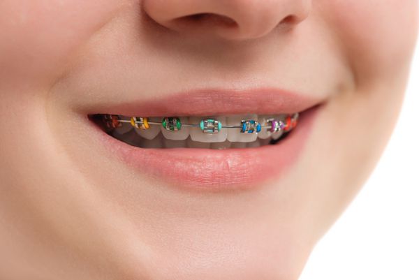 نزدیک دایره های رنگی بر روی دندان لبخند زن زیبا با پرانتزهای خودبخودی درمان ارتودنسی