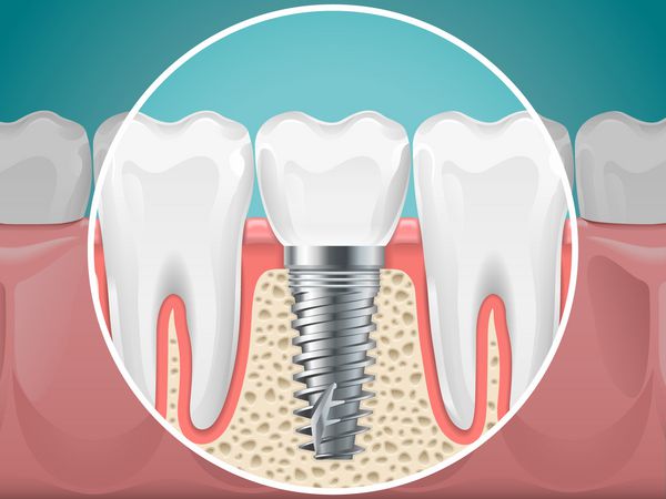تصاویر دندانپزشکی ایمپلنت دندان و دندان های سالم دندانپزشکی دندانپزشکی و ایمپلنت دندانپزشکی و نصب و راه اندازی
