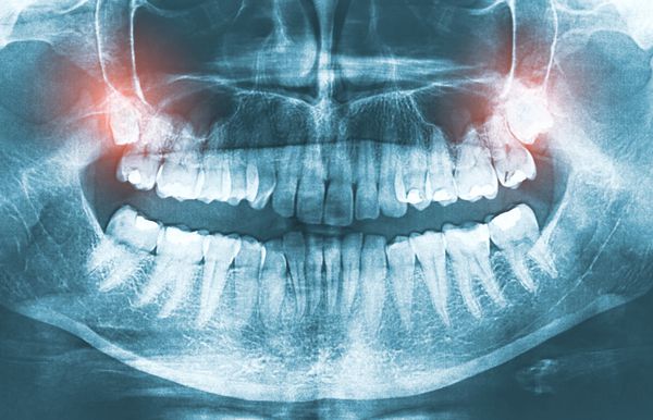 دندان درد دندان درد دندان درد دندان درد دندان درد دندان دندان