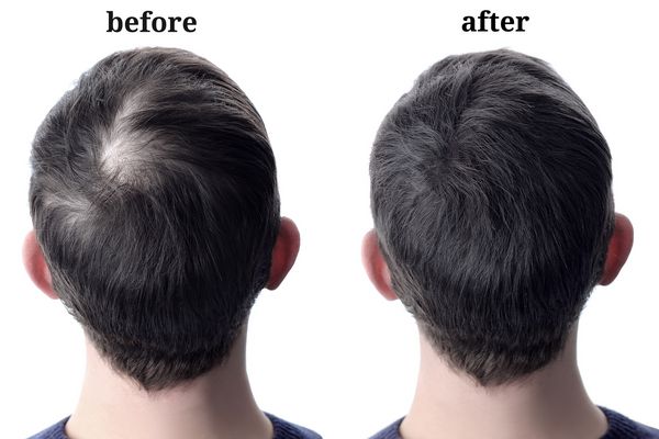 مردان amp x27؛ shair پس از استفاده از پودر آرایشی برای ضخیم کردن مو قبل و بعد