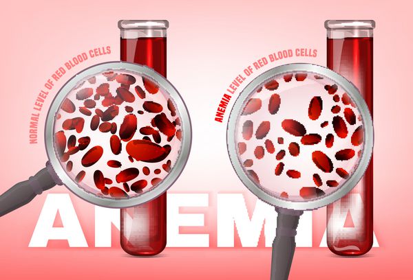 سطح طبیعی گلبول های قرمز در مقایسه با سطح کم خونی فقر آهن مفهوم پزشکی و بهداشتی تصویر برداری جدا شده در یک پس زمینه سفید