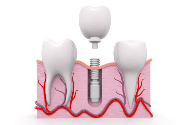 فرآیند نصب کاشت دندان ارائه 3 بعدی