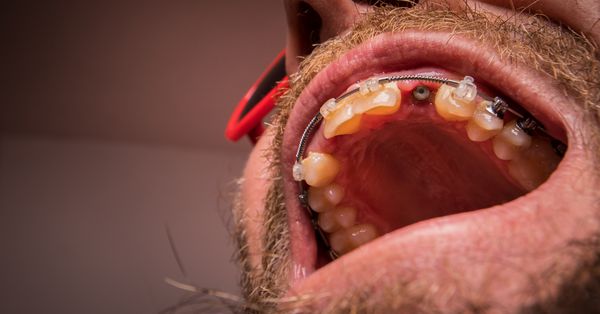 شات ماکرو از دو کاشت نصب شده در دهان انسان کاشت شفابخشی بسته شده روی کاشت شفابخشی باز و در سمت راست که توسط لثه ها و بافت ترمیم کننده احاطه شده است مهره قابل مشاهده یک کاشت در فک