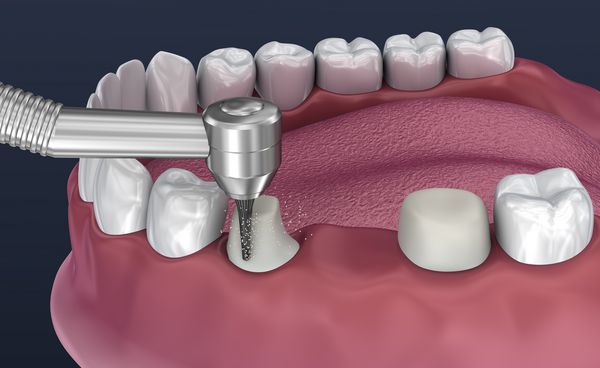 دندان از 3 دندان ثابت پشتیبانی کرد تصویر سه بعدی از نظر پزشکی دقیق