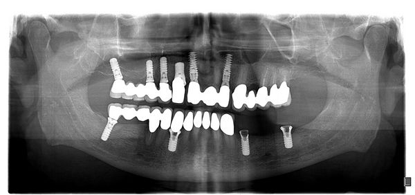 پرتونگاری دندان با مشکلات پریودنتیت پوسیدگی دندان کاشت