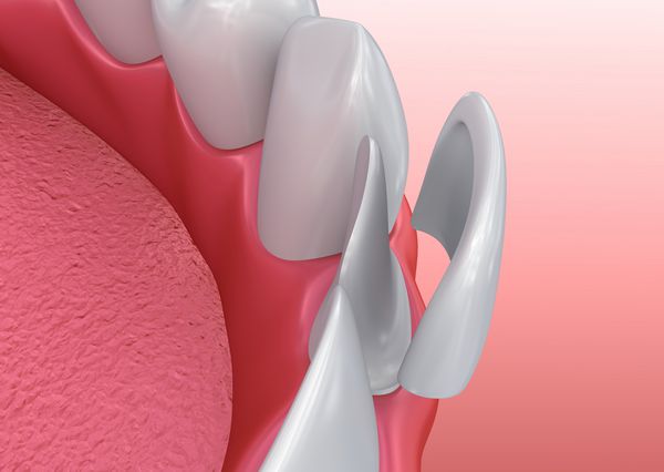 روکش های دندانپزشکی روش نصب روکش پرسلن تصویر سه بعدی
