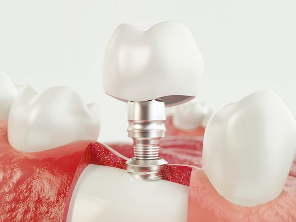 کاشت دندان دندان انسان مفهوم دندانپزشکی دندان یا دندانهای انسانی رندر سه بعدی