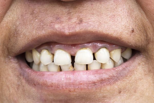 نمای نزدیک از پوسیدگی های متعدد دندان با تعداد زیادی تارتار یا محاسبه کاملاً پر شده بر روی هر دندان یک زن بیمار آسیایی